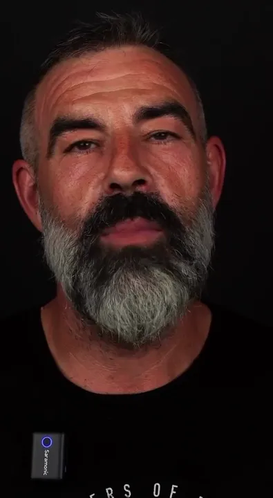 Testimonial: İspanya All-on-6 Gülüş Tasarımı